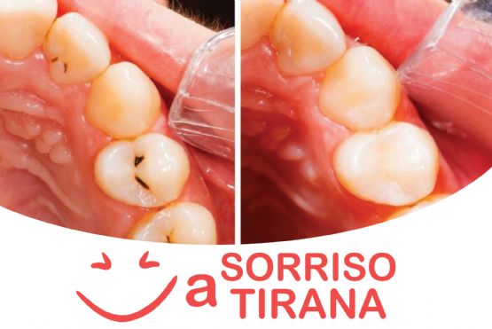 Specialista Maxi faciale, Cura dei denti, turismo dentale albania, le migliori cliniche dentali a tirana clinica dentale albania tirana, elite dental tirana, dentisti albania opinioni 